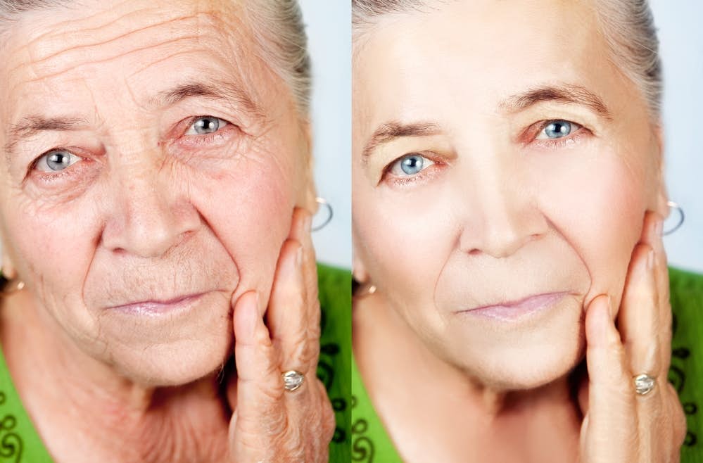 Can Botox Cut The Risk of Alzheimer's? about false