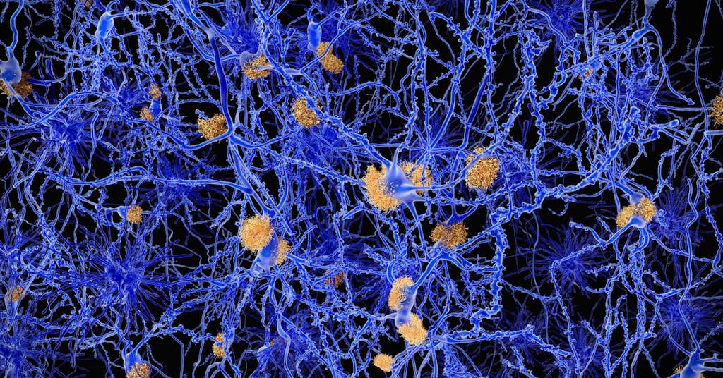New Discovery Points to an Overlooked Cause of Alzheimer’s about false