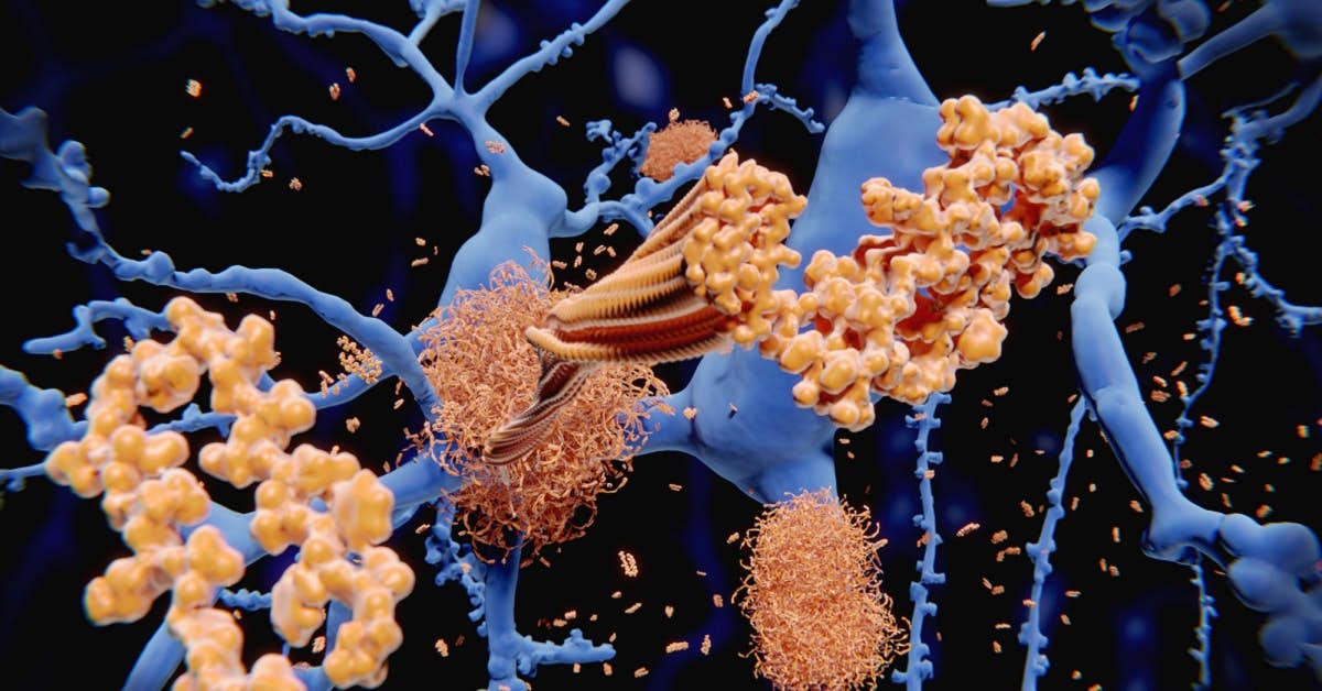 Is This the Reason Why so Many Drugs Have Failed to Beat Alzheimer’s Disease? about undefined