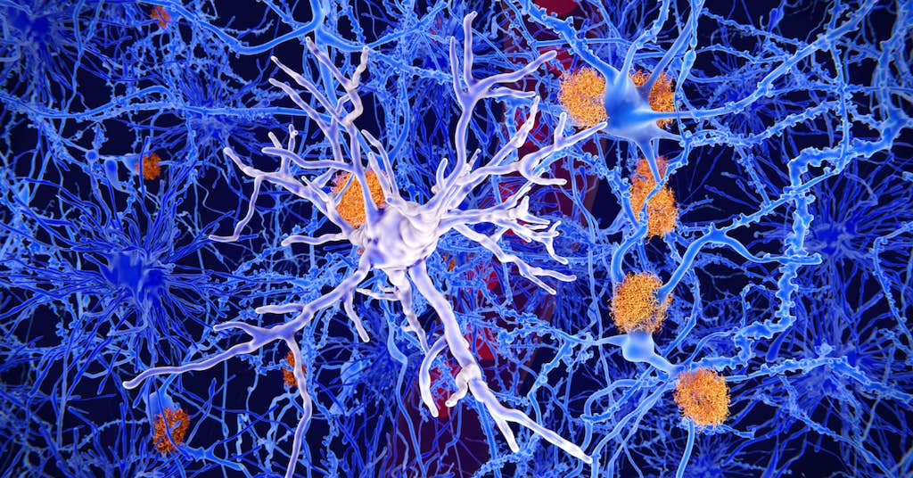 New Study Reveals Shocking Discovery About Amyloid Plaque and Memory Loss about false