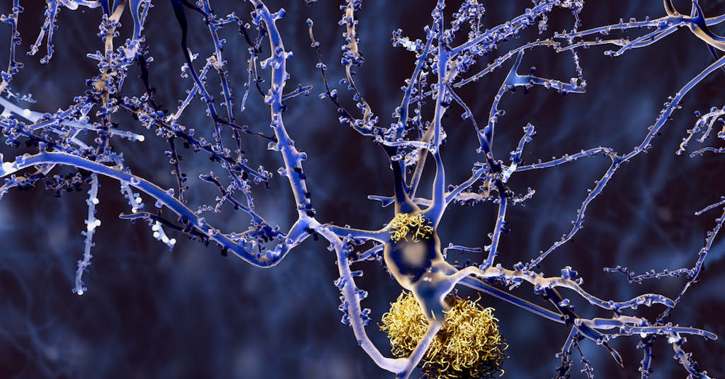 New Algorithm Might Predict Alzheimer's about false