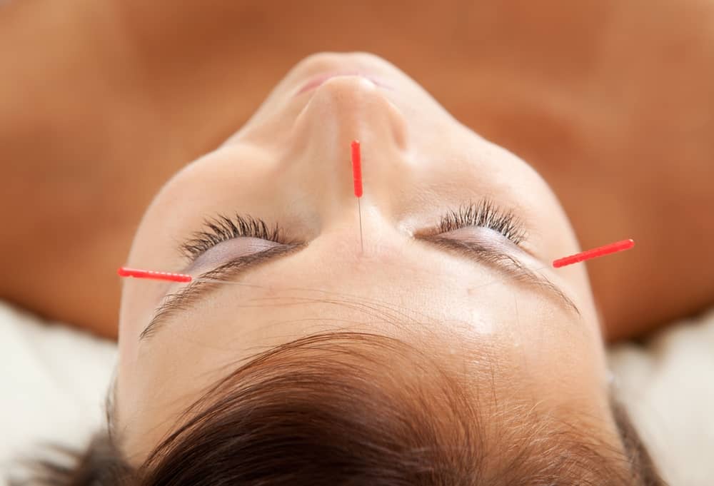 Can Acupuncture Help an Alzheimer's Patient? about undefined