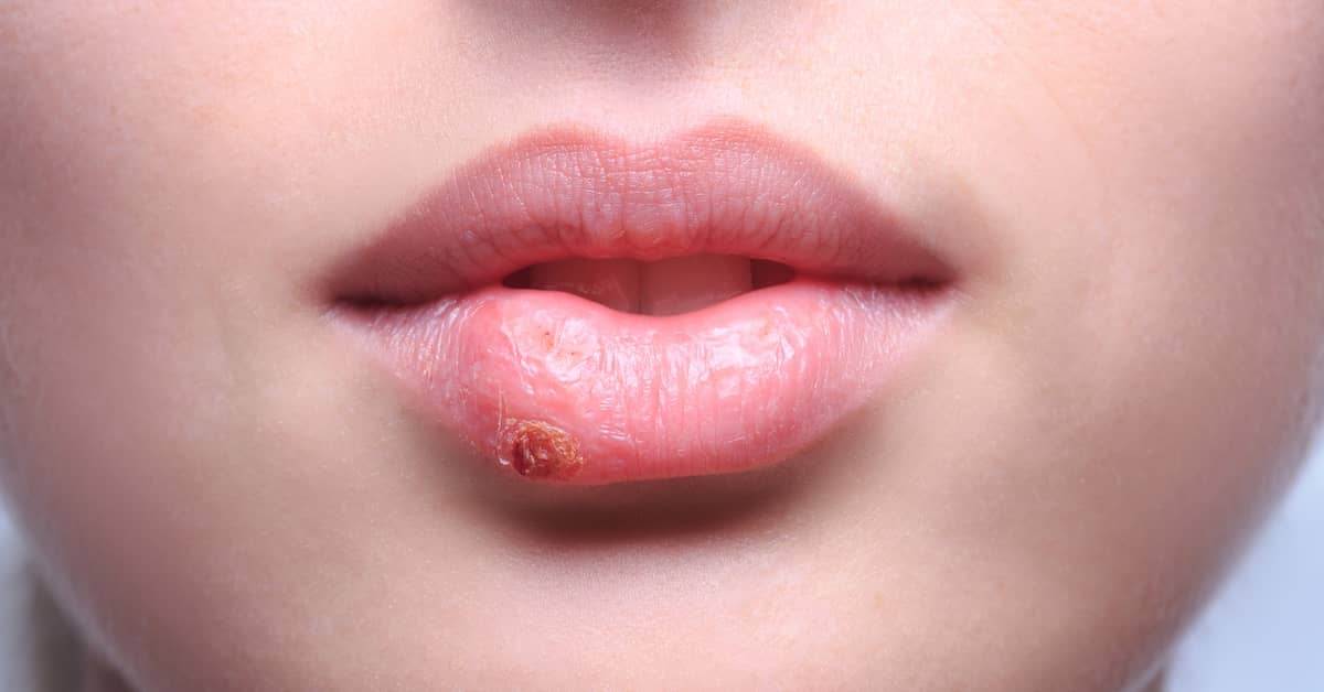 New Evidence Implicates Herpes as a Cause of Alzheimer's about undefined