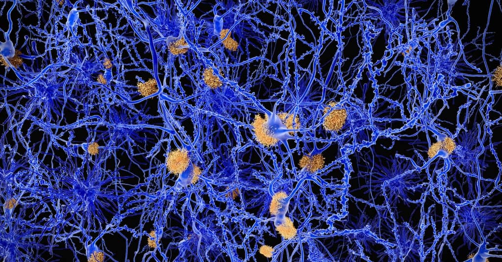 New Discovery Points to an Overlooked Cause of Alzheimer’s about false