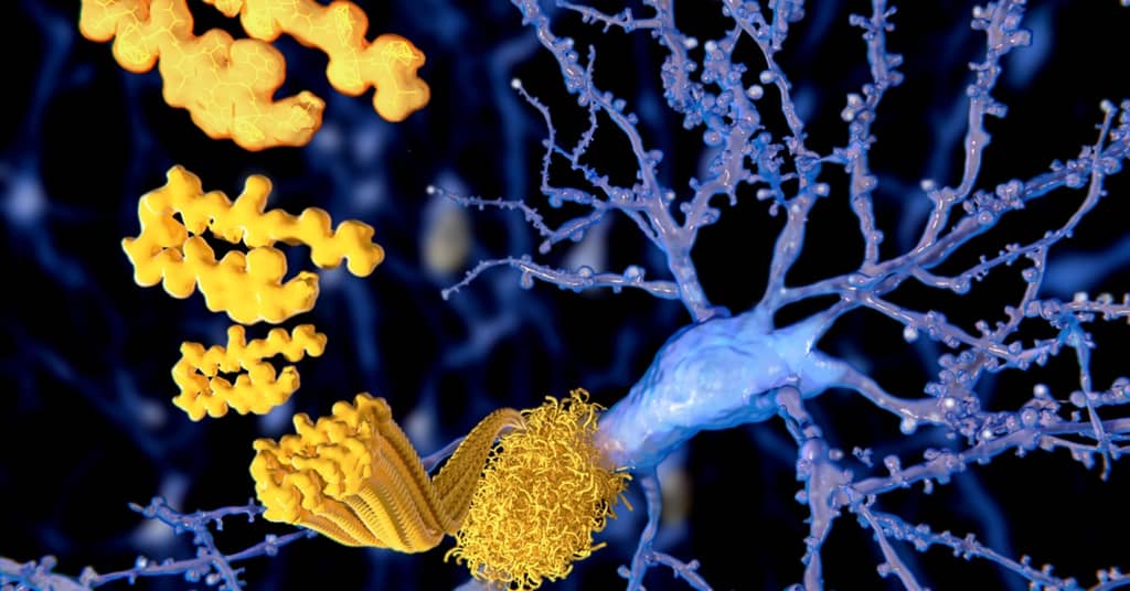 It's No Longer a Theory - Inflammation is Proven to Grow Brain Plaques about false