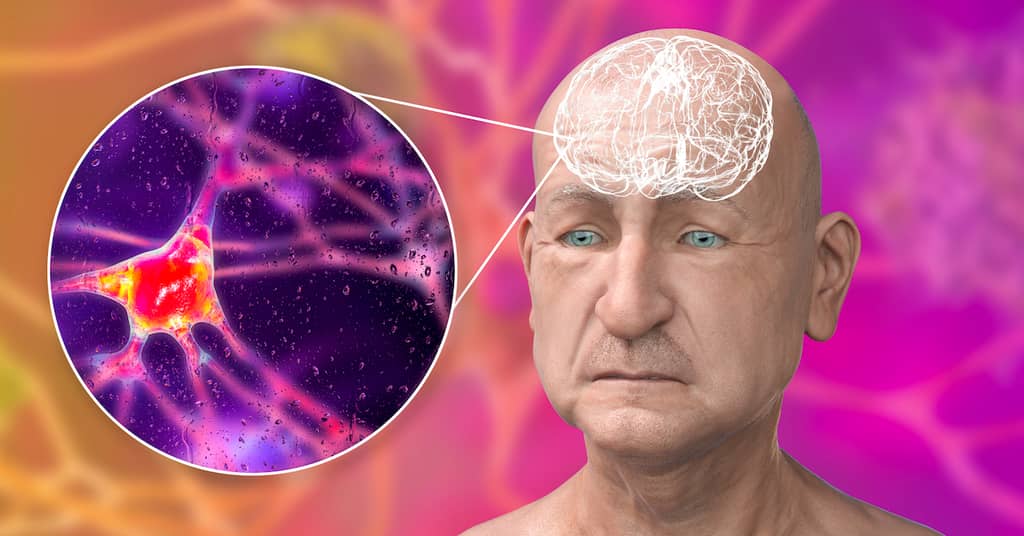 Why Doctors Miss Early-Onset Dementia And the Surprising Symptom That’s a Dead Giveaway… about false