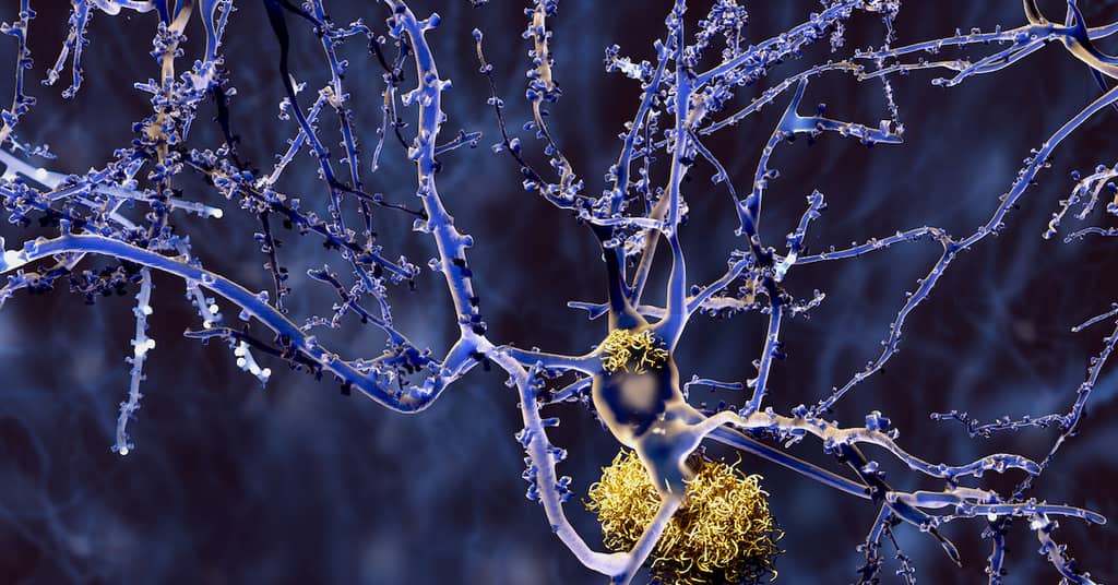 New Algorithm Might Predict Alzheimer's about false