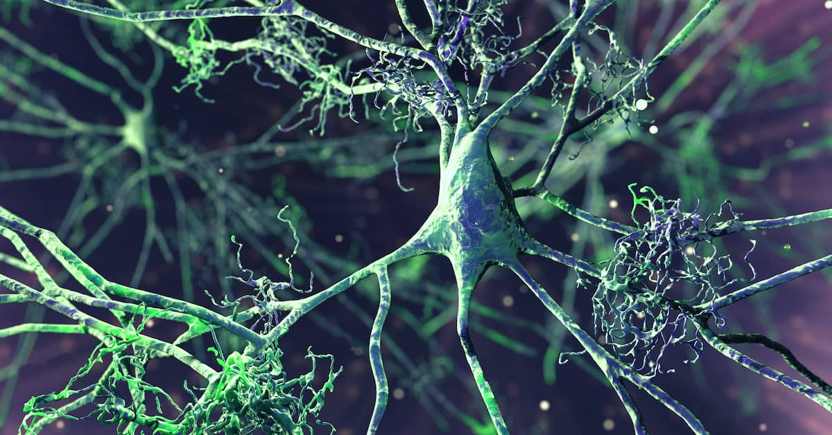 New Nose Spray Shows Promise as an Alzheimer’s Treatment about undefined