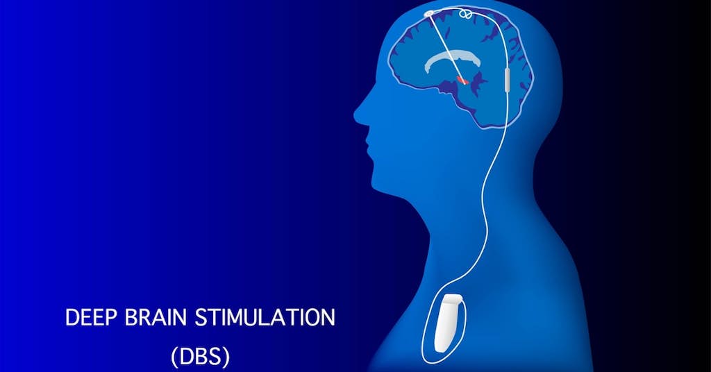 Revolutionary “Brain Pacemaker” Reverses Symptoms of Parkinson’s Disease about false