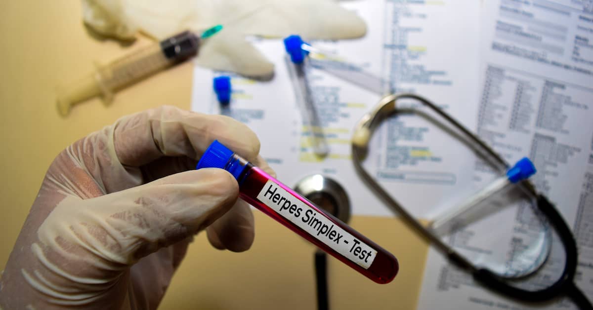Solving This Viral Puzzle Unlocks Cause (And Maybe Treatment For) Alzheimer’s Disease about undefined