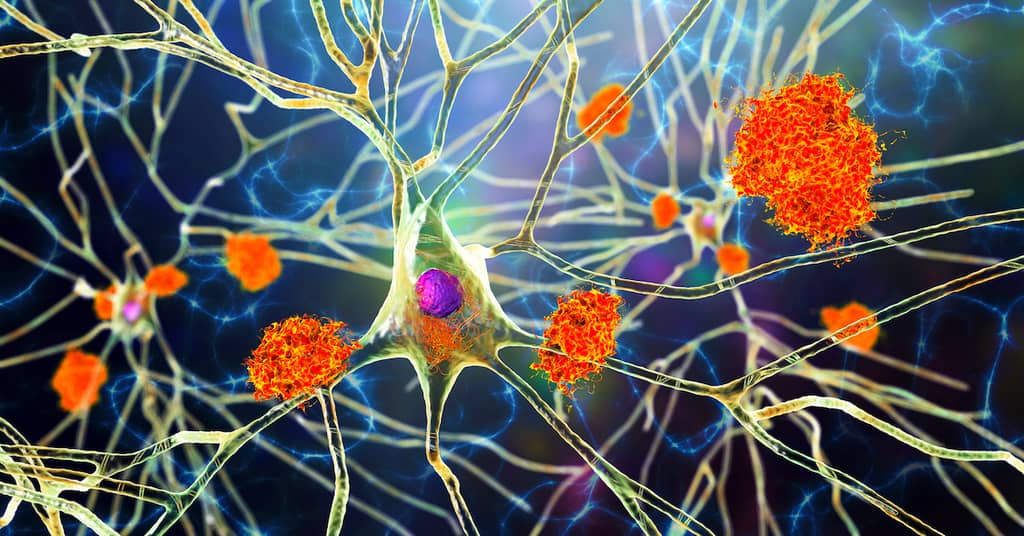 Why Not Everyone With Brain Plaque Gets Alzheimer’s Disease about false