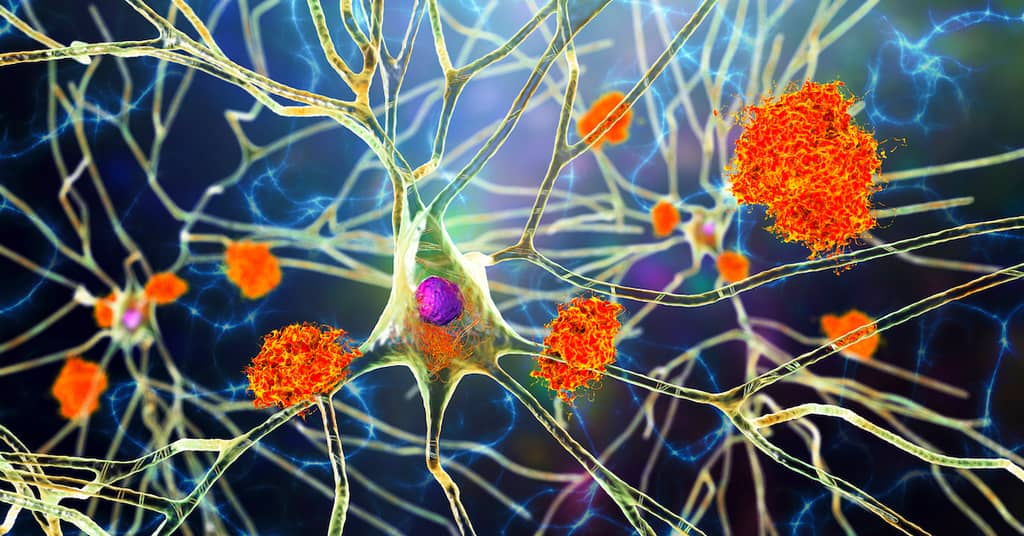 Is This The REAL Cause Of Alzheimer’s Disease? (And What You Can Do About It…) about false